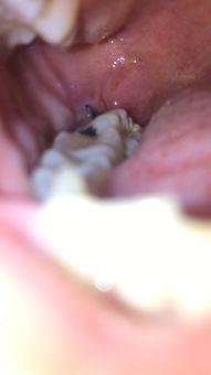 拔跖疣视频,轻松去除脚部疣体