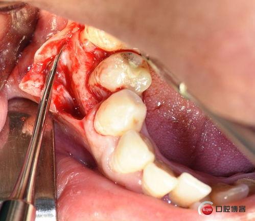 根尖囊肿手术视频,专业视角下的微创治疗技术
